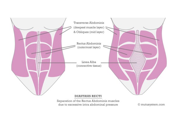 Illustration of Diastis Recti from <a href="http://mutusystem.com/diastasis-recti-diagram-the-muscles-involved.html" target="_blank">The MuTu System</a>